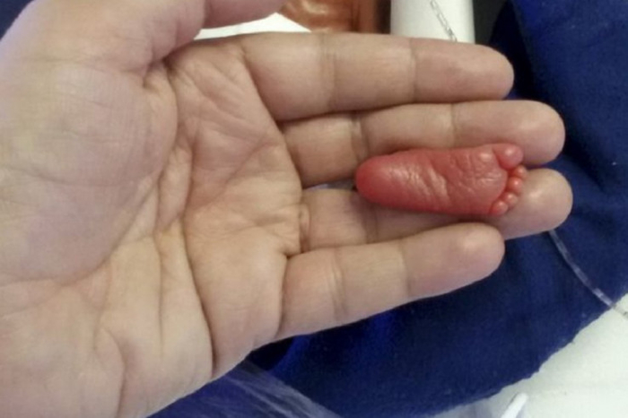 Вистинско чудо од бебе: Девојче родено само со 400 грама (ФОТО)