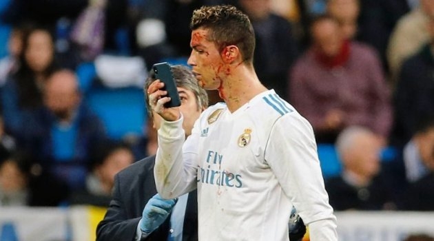 ВИДЕО: Реал ја покажа исекотината на лицето која ја доби Роналдо