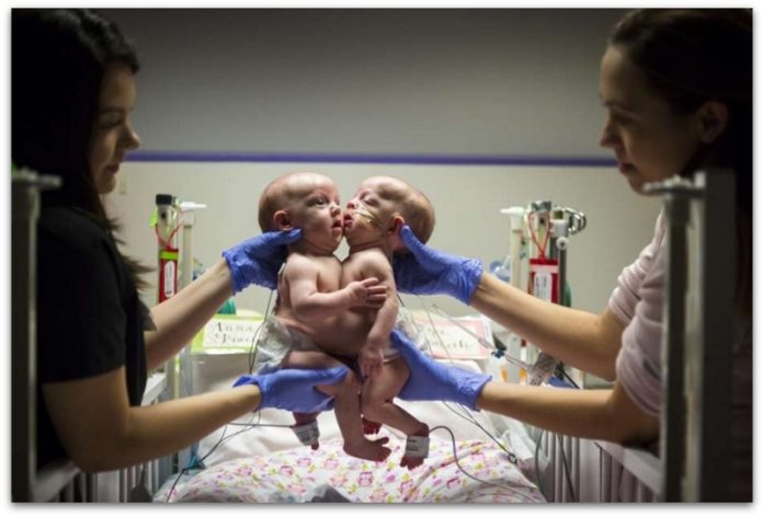 ВИДЕО: Успешно раздвоени сијамски близначки кои беа споени во градниот кош и стомакот