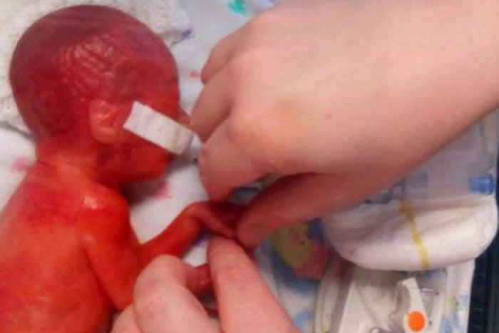 ФОТО: Родена е еден ден по лимитот за абортус – Никој не верувал дека ќе преживее, а еве како изгледа денес