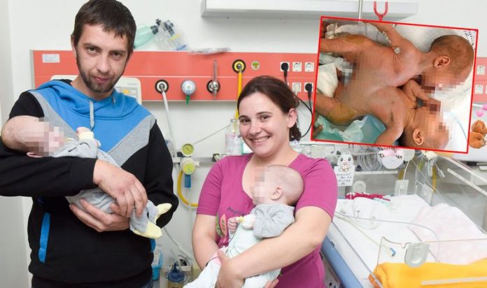 По 15 часа операција хрватски лекари успешно раздвоија сијамски близнаци (ВИДЕО)