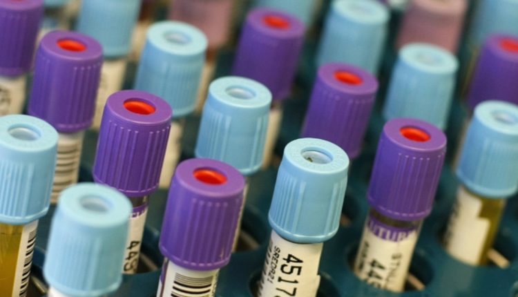 ЕУ финансира набавка на брзи тестови за коронавирус