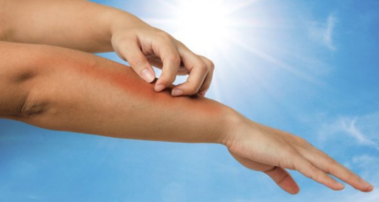 Алергијата од сонце за многумина е голем проблем, еве како да се заштитите навреме