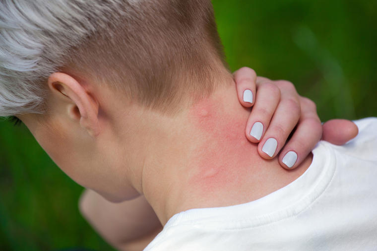 Комарците почнаа да “напаѓаат“, еве како да го ублажите чешањето и црвенилото