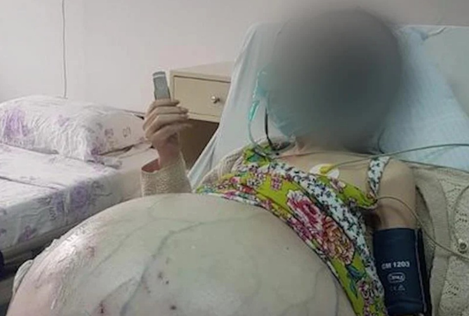На скопска Гинекологија извадена циста тешка 90 килограми од 45-годишна жена (В*ЗНЕМ*РУВАЧКО ВИДЕО)