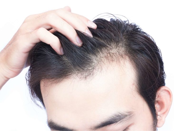 Истражување: Луѓето кои прележале Ковид-19 се соочуваат и со опаѓање на косата