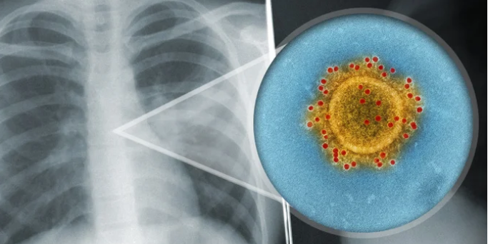 И покрај негативниот ПЦР-тест, некои пациенти имаат клинички знаци на инфекција од коронавирус во белите дробови