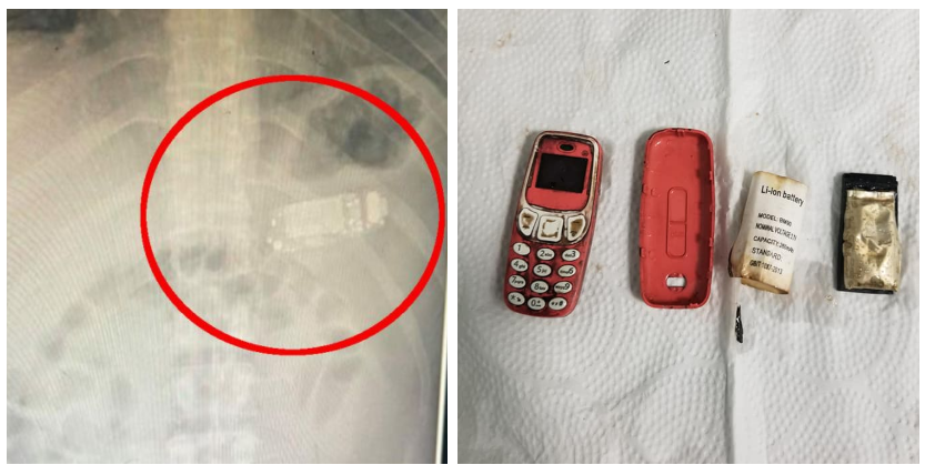 НЕВИДЕН МЕДИЦИНСКИ СЛУЧАЈ: На маж во Косово му е oтстранет мобилен телефон од стомак – со денови му бил во утробата! (ФОТО)