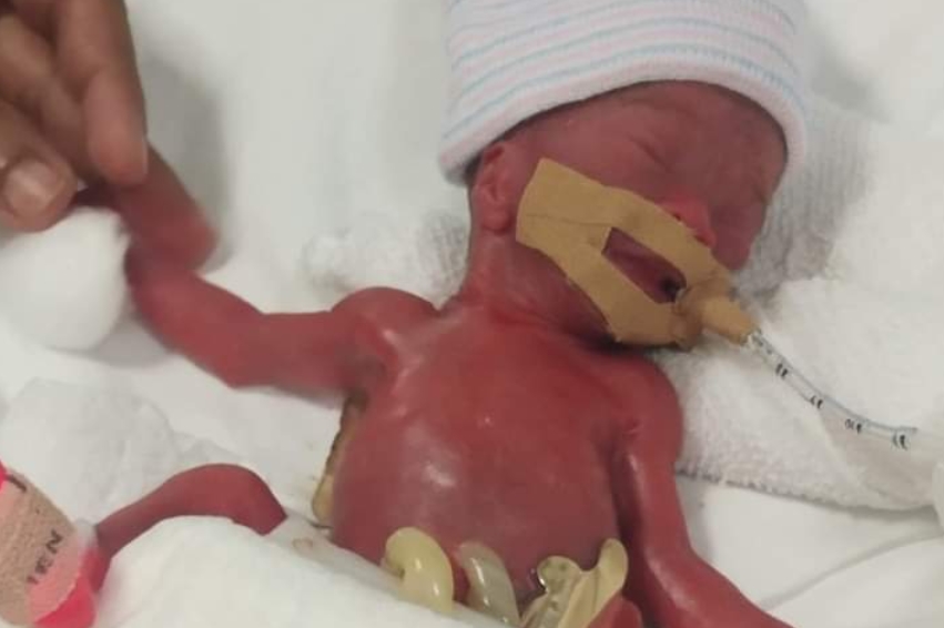 ФОТО: Најмалото бебе на светот си замина дома – Се роди со 212 грама, а еве како изгледа сега по 13 месеци во болница