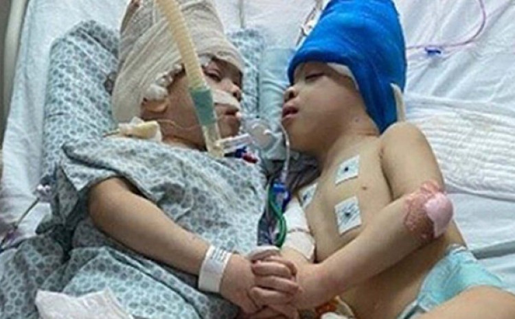 ВИДЕО: Доктори во Бразил успешно одвоиле близнаци кои имале споен мозок