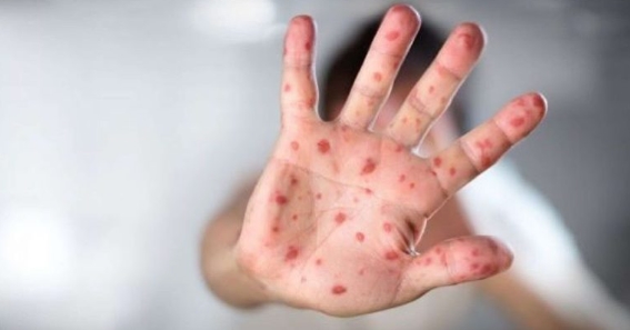 Зголемен бројот на заболени деца од варичела во Куманово